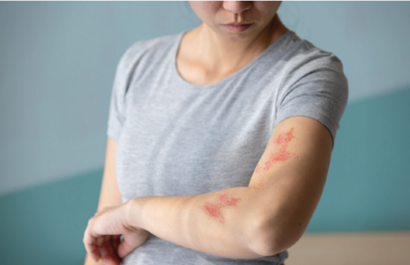 Crew Health Advice: Herpes Zoster