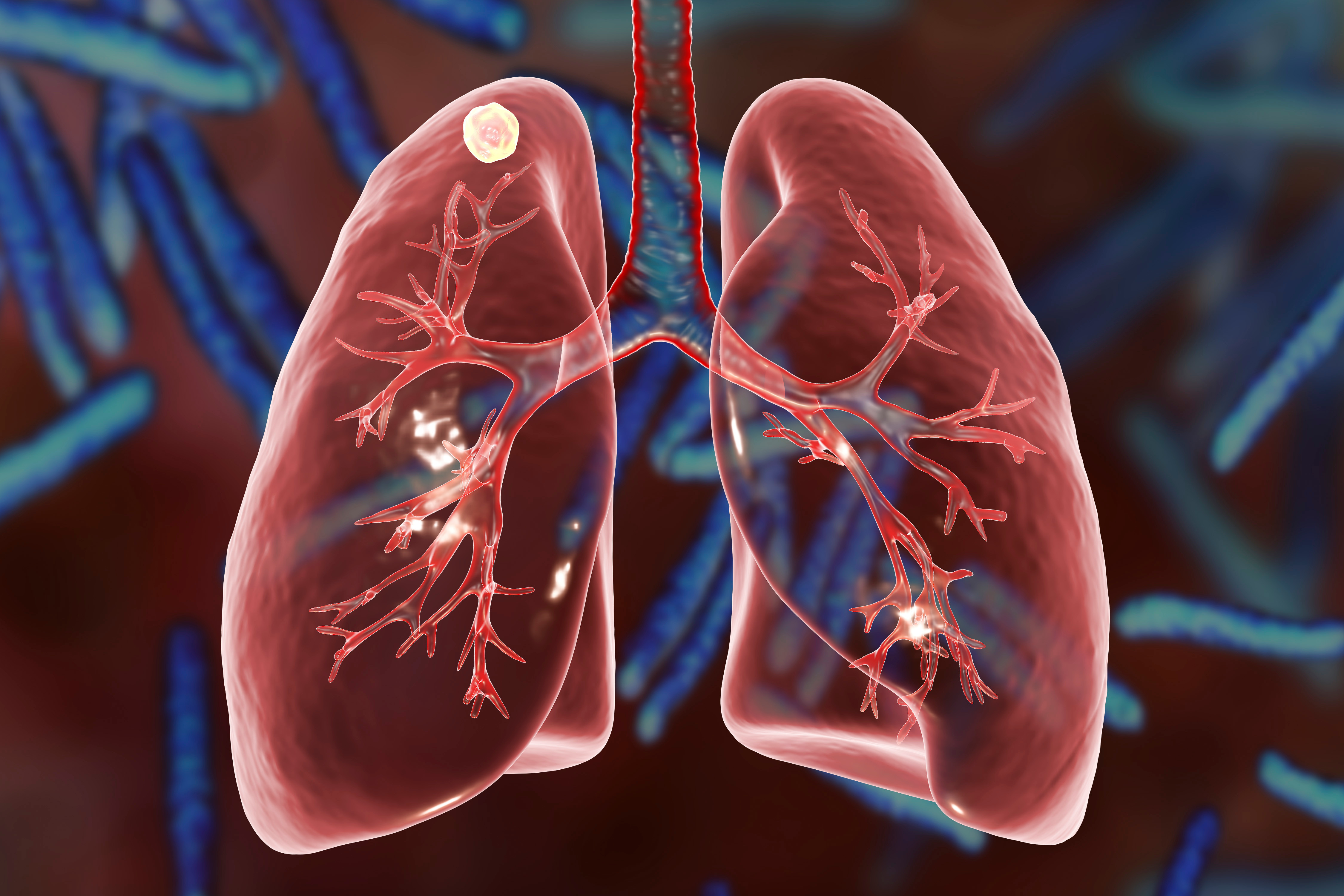 Crew Health Advice: Pulmonary Tuberculosis